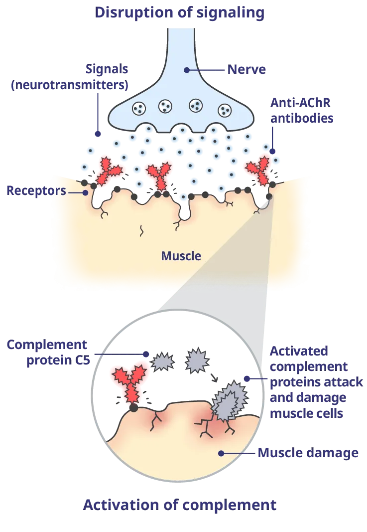 Harmful antibodies disrupt these signals and activate the complement system, resulting in damage to the muscle cells and the symptoms of gMG.