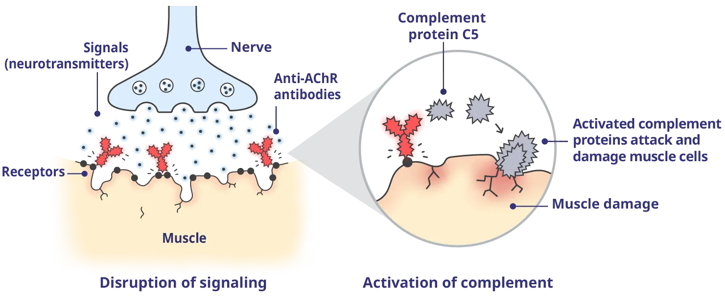 Harmful antibodies disrupt these signals and activate the complement system, resulting in damage to the muscle cells and the symptoms of gMG.