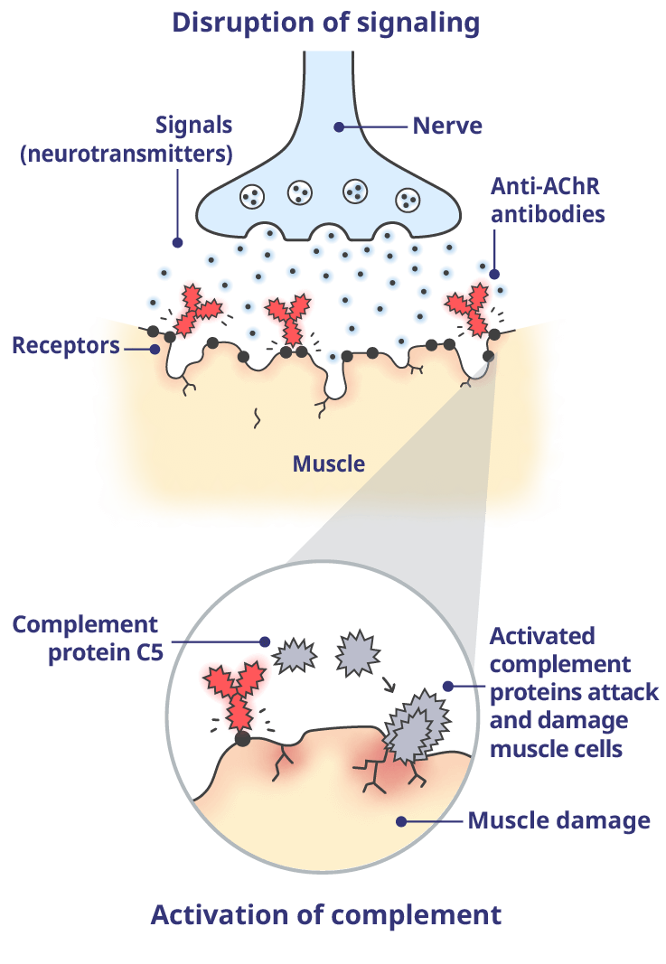 Harmful antibodies disrupt these signals and activate the complement system, resulting in damage to the muscle cells and the symptoms of gMG.
