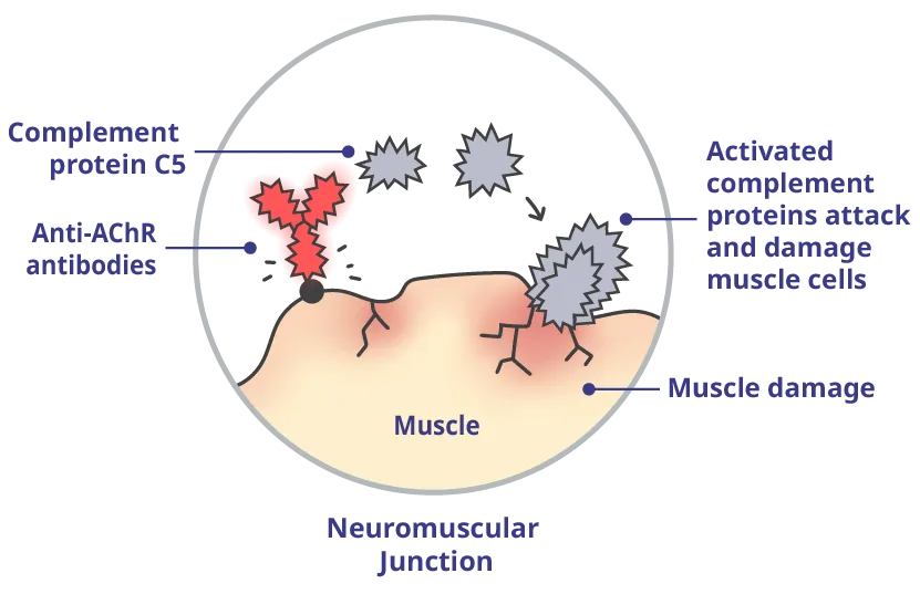 Anti-AChR antibody activates complement proteins that damage the muscle and interrupt signals.