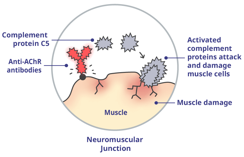 Anti-AChR antibody activates complement proteins that damage the muscle and interrupts signals.